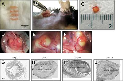 Factors Promoting Development of Fibrosis in Crohn’s Disease